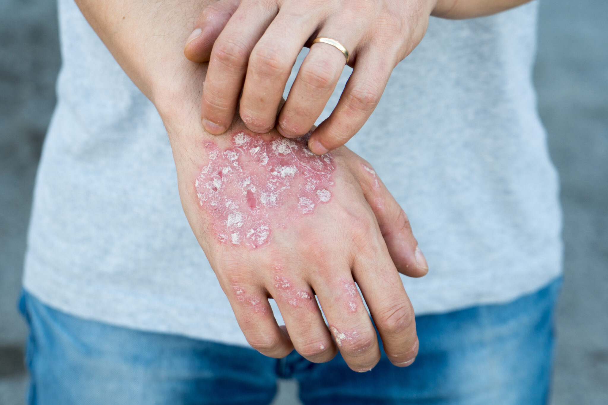 AbbVie faz conscientização sobre dermatite atópica