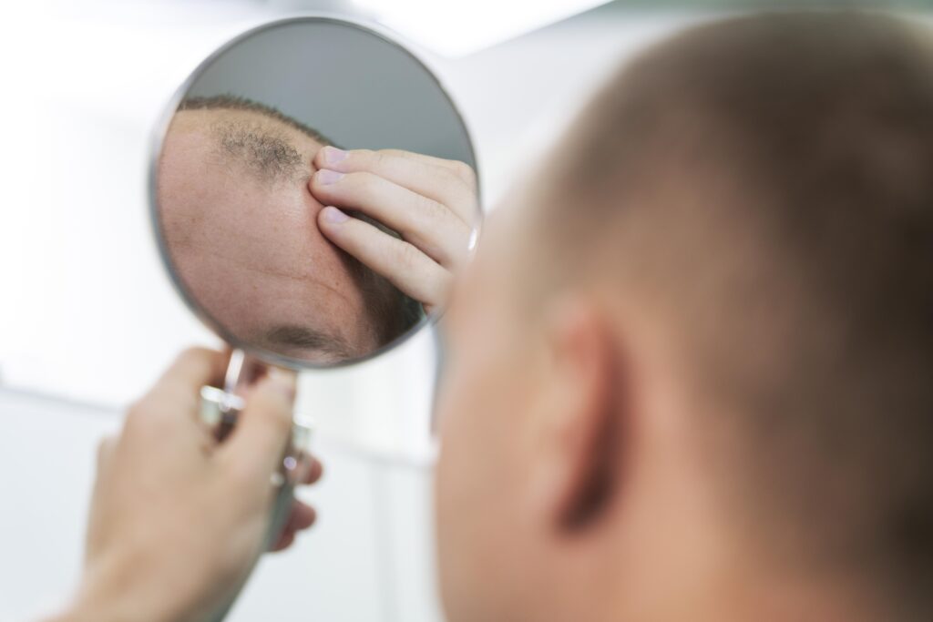 Medicamento da Aché ganha nova atuação contra calvície masculina